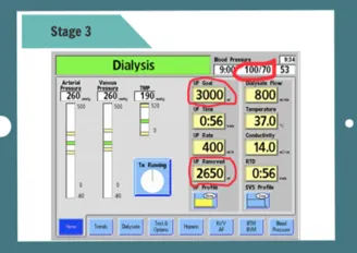 Treatment monitoring screens, key numbers to watch during dialysis